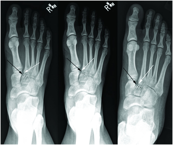 Lisfranc, Fig1