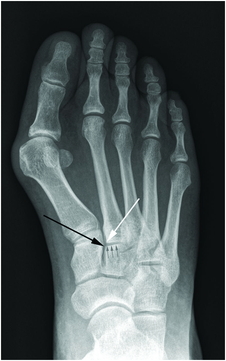 Lisfranc, Fig2