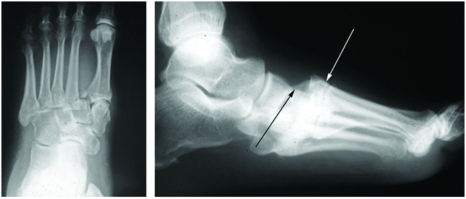 Lisfranc, Fig3