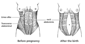 Picture, Changes in the Abdominal Muscles