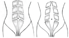 Picture, Diastasis Recti (Normal & Gap)