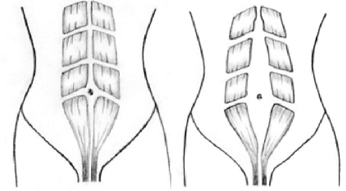 Picture, Diastasis Recti (Normal & Gap)