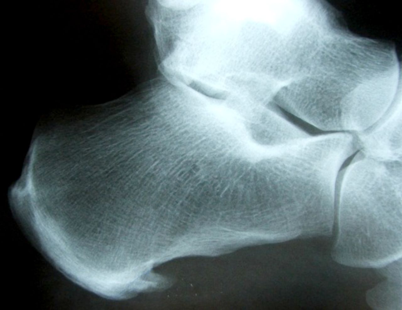 Figure 3: X ray of calcaneal spur.