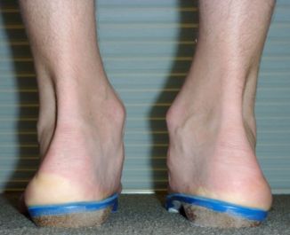 Figure 5: Custom-made orthotics.