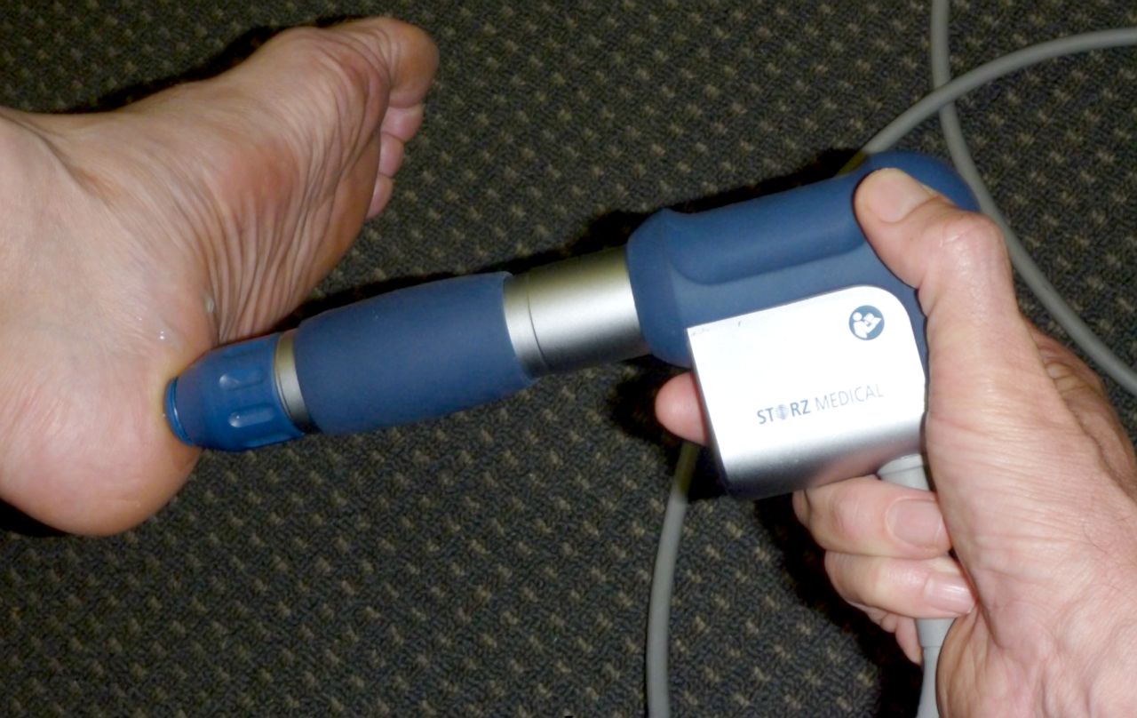 Figure 9: Extracorporeal shock wave therapy being applied to the plantar fascia.
